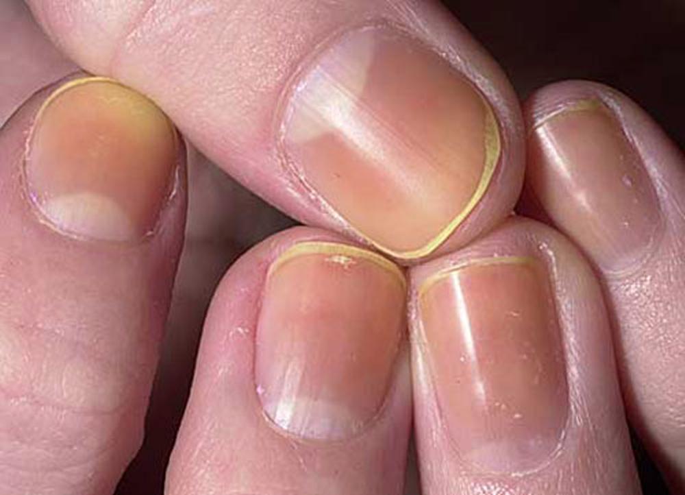 These hacks will help you get rid of those yellow nails - The Brown Identity
